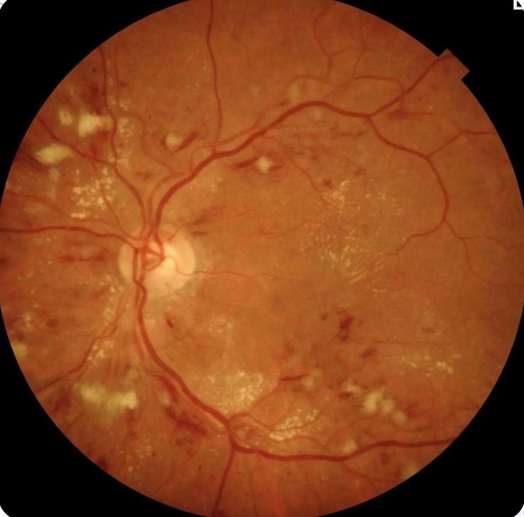 Diabetic_Retinopathy_at-Dr_KP_Eye_Care_Centre_Chandigarh