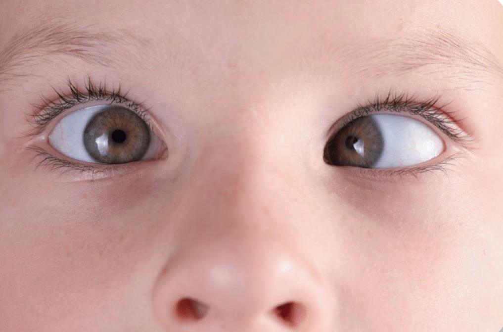 squint-treatment-at-dr-kp-singh-eye-care-centre
